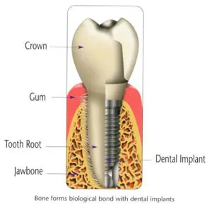 dental-implants-dallas-texas