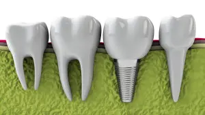 dental implants dallas