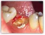 functional-crown-lengthening-dallas-tx-1