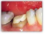 functional-crown-lengthening-dallas-tx-2