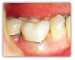 functional-crown-lengthening-dallas-tx-3