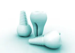 dental implants Dallas