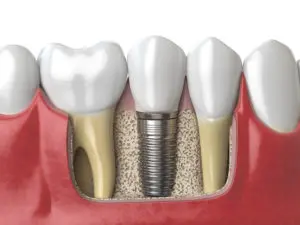 tooth implant Dallas