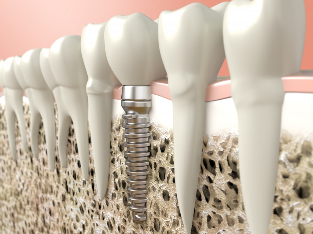 Dallas Periodontist Explains Using Dental Implants With Receding Gums