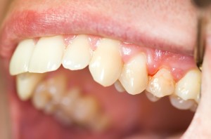 periodontal disease