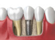 tooth implant Dallas