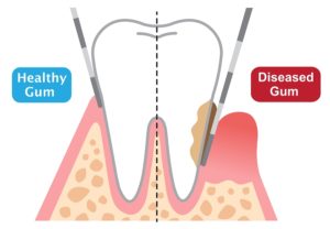 periodontal surgery Dallas