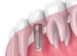 tooth implant Dallas