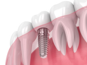 tooth implant Dallas