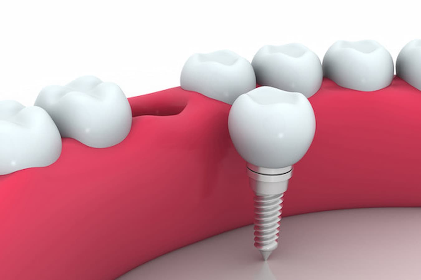 dental implants Dallas